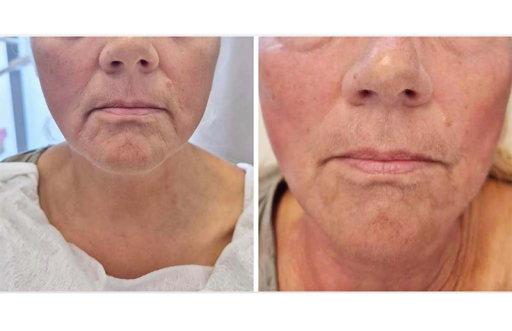 zabieg kosmetologiczny