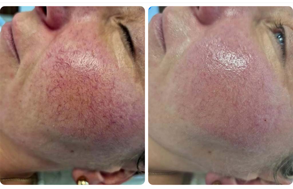 zabieg kosmetologiczny