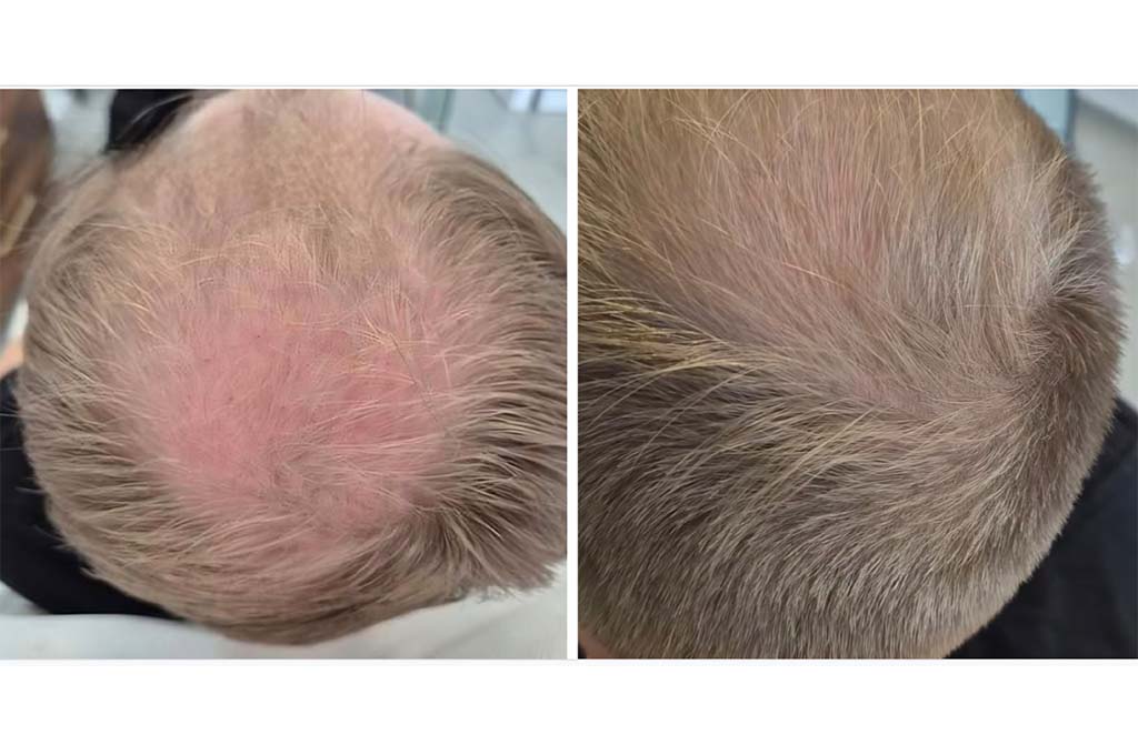 zabiegi trychologiczne