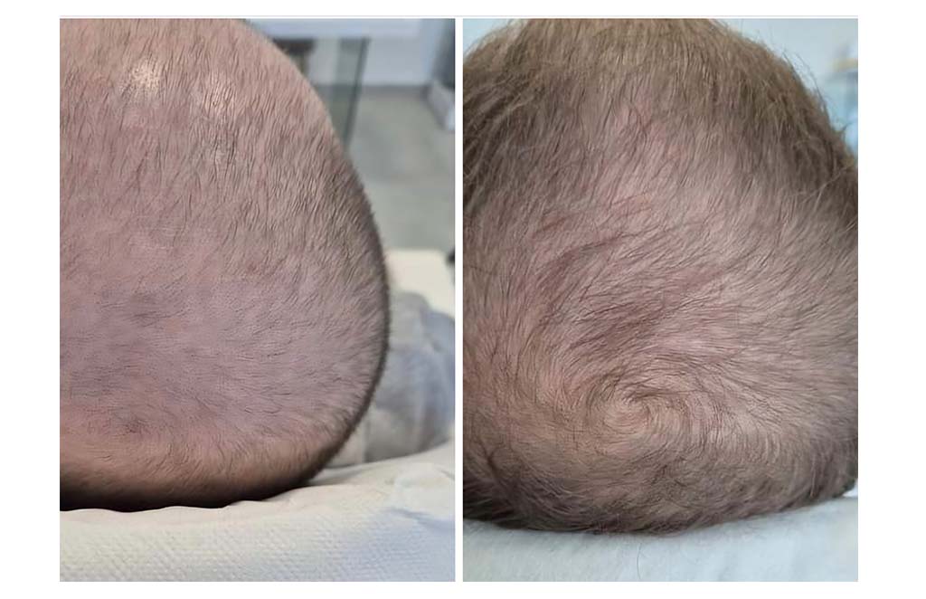 zabiegi trychologiczne